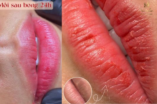 khử thâm môi bằng laser 2